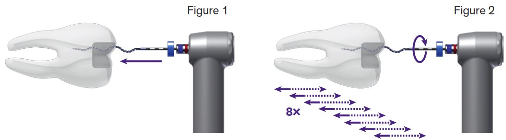BRASSELER XP-3D Shaper and Finisher Endo Files with Prokit - Description 2