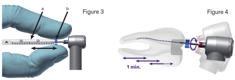 BRASSELER XP-3D Shaper and Finisher Endo Files with Prokit - Description 4